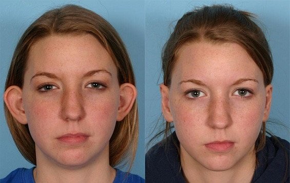 Otoplastia Antes e Depois