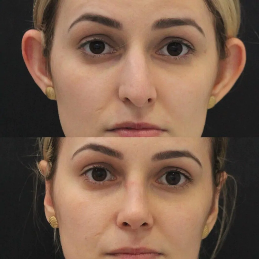 resultado-otoplastia-antes-e-depois-1-1024x1024