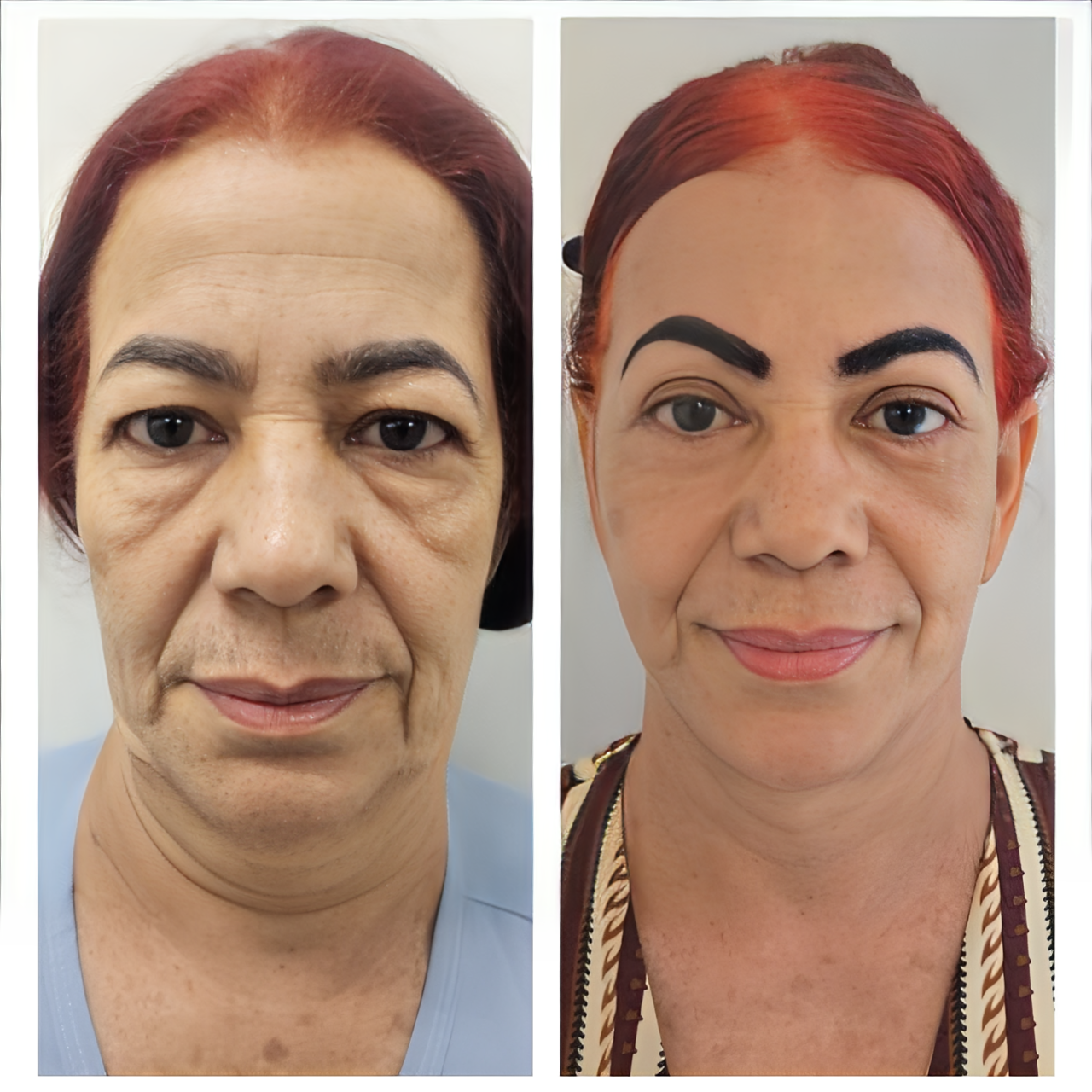Antes e Depois cirurgia facial 2