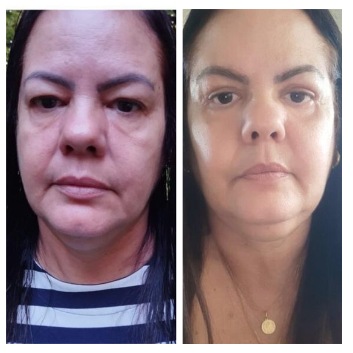 Antes e Depois cirurgia facial 3