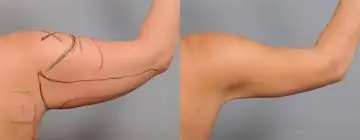 Braquioplastia